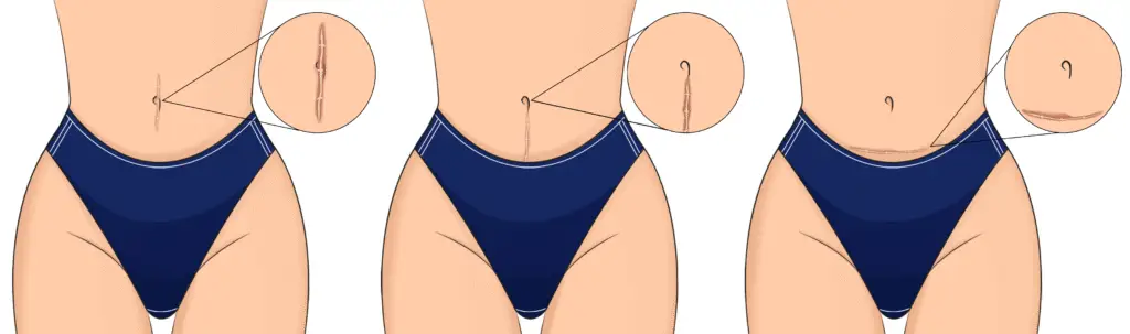 CICATRIZ CESAREA 1024x303