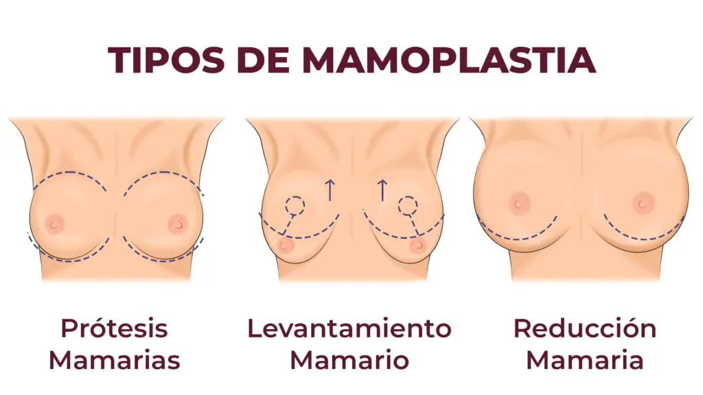 Tipos De Mamoplastia 1024x576
